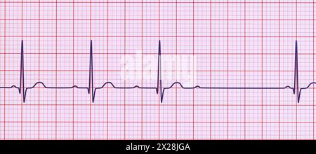 EKG mit AV-Block 2. Grades, Abbildung Stockfoto