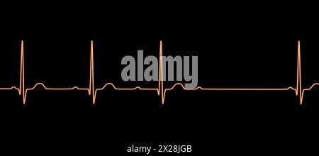 EKG mit AV-Block 2. Grades, Abbildung Stockfoto