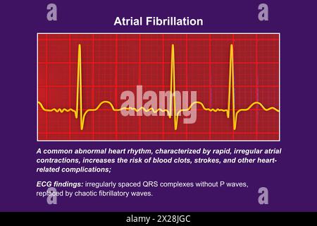 EKG bei Vorhofflimmern, Illustration Stockfoto