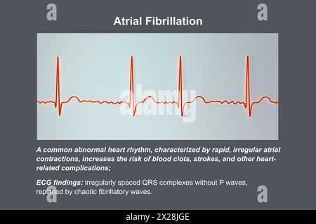 EKG bei Vorhofflimmern, Illustration Stockfoto