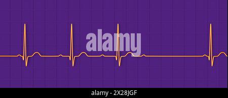 EKG mit AV-Block 2. Grades, Abbildung Stockfoto