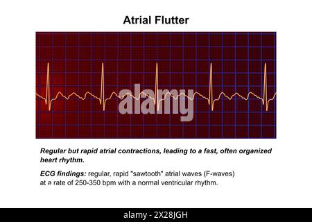 EKG bei Vorhofflattern, Illustration Stockfoto