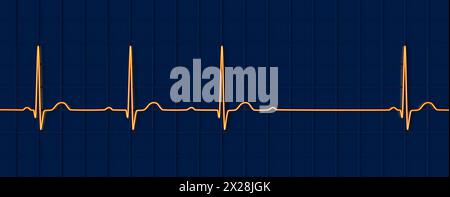 EKG mit AV-Block 2. Grades, Abbildung Stockfoto