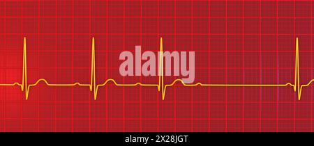 EKG mit AV-Block 2. Grades, Abbildung Stockfoto