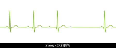 EKG mit AV-Block 2. Grades, Abbildung Stockfoto