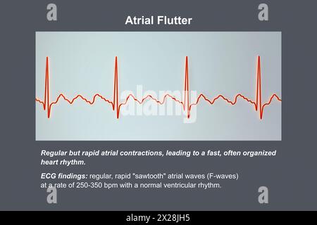 EKG bei Vorhofflattern, Illustration Stockfoto