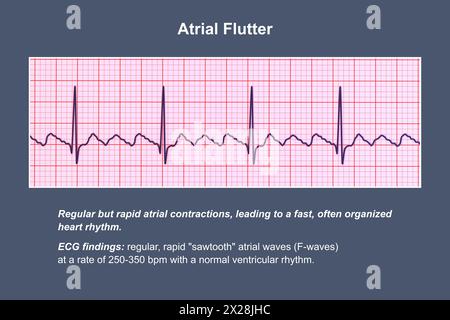 EKG bei Vorhofflattern, Illustration Stockfoto