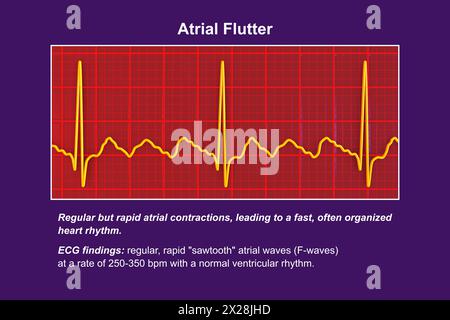 EKG bei Vorhofflattern, Illustration Stockfoto