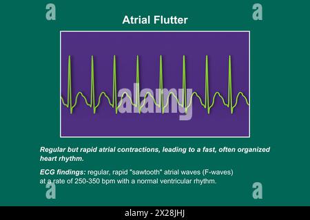 EKG bei Vorhofflattern, Illustration Stockfoto