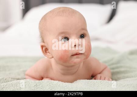 Niedliches kleines Baby mit allergischer Rötung auf den Wangen, das zu Hause auf dem Bett liegt Stockfoto