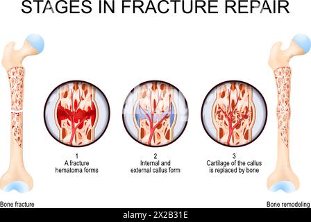 Stadien der Frakturreparatur. Von Knochenbrüchen und Hämatomformen bis hin zu Knorpel des Kallus wird durch Knochen- und Knochenumbau ersetzt. Vektorillustraten Stock Vektor