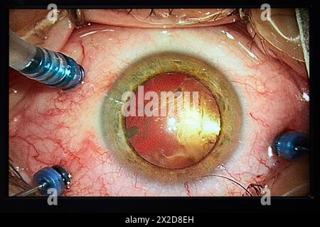 Bild des Auges, chirurgische Intervention der Augen, Katarakt, Operationssaal der Augenheilkunde, Krankenhaus Donostia, San Sebastian, Gipuzkoa, Baskenland Cou Stockfoto