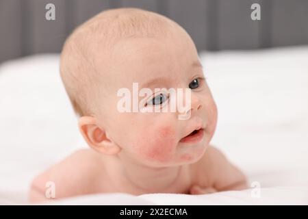 Niedliches kleines Baby mit allergischer Rötung auf den Wangen, das zu Hause auf dem Bett liegt Stockfoto