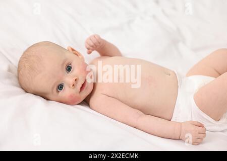 Süßes kleines Baby mit allergischer Rötung auf den Wangen, die auf weißer Decke liegen Stockfoto