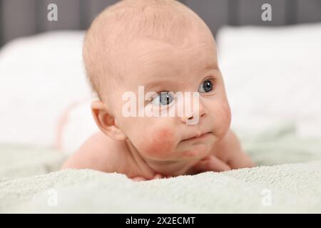 Niedliches kleines Baby mit allergischer Rötung auf den Wangen, das zu Hause auf dem Bett liegt Stockfoto