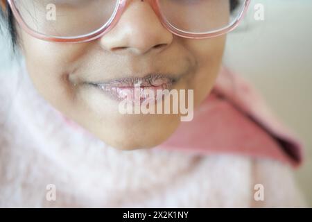Nahaufnahme der trockenen Lippe eines Kindes Stockfoto