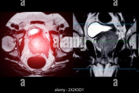 Die MRT der Prostata zeigt eine fokale Läsion mit abnormer Signalintensität (SI) an den linken posterolateralen peripheren Zonen am Apex, was bei Durchm hilft Stockfoto