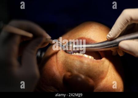 Ein erwachsener Mann wird von einem Zahnarzt gesehen, der mit einem Bohrer eine Kavität in einem Backenzahn repariert. Stockfoto