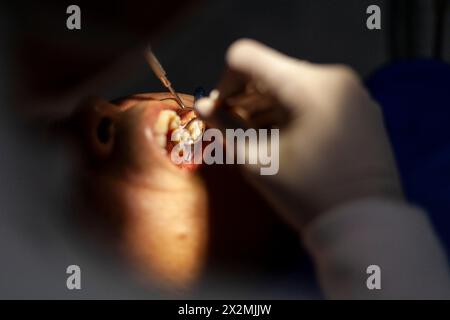 Ein erwachsener Mann wird von einem Zahnarzt gesehen, der mit einem Bohrer eine Kavität in einem Backenzahn repariert. Stockfoto
