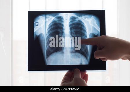 Lungenradiographiekonzept. Röntgenarzt am Thoraxröntgenfilm eines Patienten mit Lungenkrebs oder Lungenentzündung. Virus und Bakterien infizierten den Menschen Stockfoto