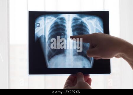 Lungenradiographiekonzept. Röntgenarzt am Thoraxröntgenfilm eines Patienten mit Lungenkrebs oder Lungenentzündung. Virus und Bakterien infizierten den Menschen Stockfoto