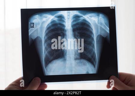 Lungenradiographiekonzept. Röntgenarzt am Thoraxröntgenfilm eines Patienten mit Lungenkrebs oder Lungenentzündung. Virus und Bakterien infizierten den Menschen Stockfoto