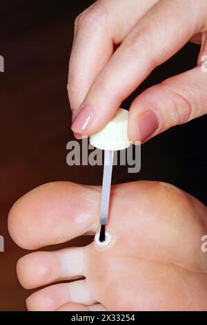 Anwendung von Salicylsäure-Arzneimitteln bei Warzen an weiblichen Füßen. Konzentrieren Sie sich auf die Füße Stockfoto