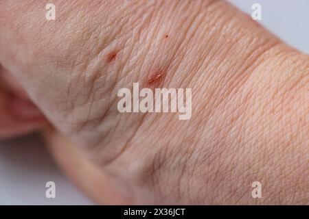 Nahaufnahme von Kratzern an der Handgelenkshaut. Eine Wunde, die von einer Katze verursacht wurde. Selektiver Fokus Stockfoto
