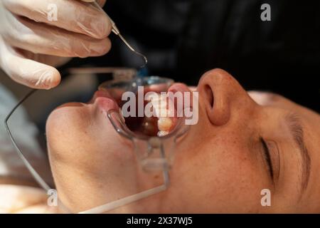 Nahaufnahme eines kieferorthopädischen Spezialisten, der unsichtbare Aligner an einer Latina-Frau justiert und platziert. Das Konzept der unsichtbaren kieferorthopädischen Technik. Stockfoto