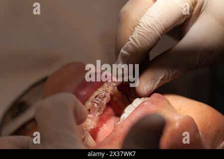 Nahaufnahme eines kieferorthopädischen Spezialisten, der unsichtbare Aligner an einer Latina-Frau justiert und platziert. Das Konzept der unsichtbaren kieferorthopädischen Technik. Stockfoto