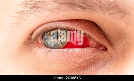Menschliches Auge mit Blutbild Nahaufnahme. Stockfoto