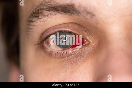 Blutunterlaufenes menschliches Auge mit auffälliger subkonjunktivaler Blutung. Blut im Augapfel, Nahaufnahme. Stockfoto