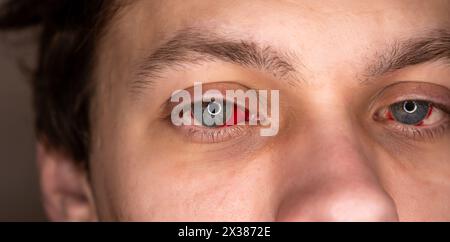 Blutunterdrücktes Auge mit roten Venen. Gefässbrüche. Wunde, entzündete Augäpfel aus der Nähe. Stockfoto
