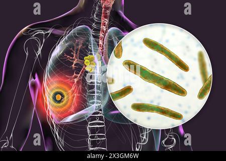 Illustration der primären Lungentuberkulose mit Ghon-Komplex und mediastinaler Lymphadenitis mit Nahaufnahme von Mycobacterium tuberculosis-Bakterien. Stockfoto