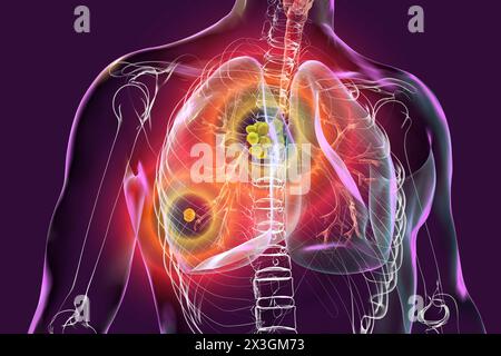Illustration der primären Lungentuberkulose mit Ghon-Komplex und mediastinaler Lymphadenitis. Stockfoto
