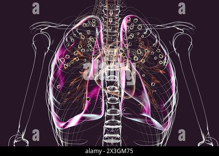 Abbildung der Lungen, die von Silikose in einem transparenten menschlichen Körper betroffen sind, wobei die Atemwegsprobleme aufgrund der Kieselsäure-Exposition hervorgehoben werden und dunkle silikotische Knoten sichtbar werden. Stockfoto
