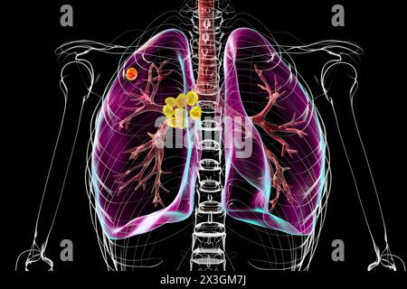 Illustration der primären Lungentuberkulose mit Ghon-Komplex und mediastinaler Lymphadenitis. Stockfoto