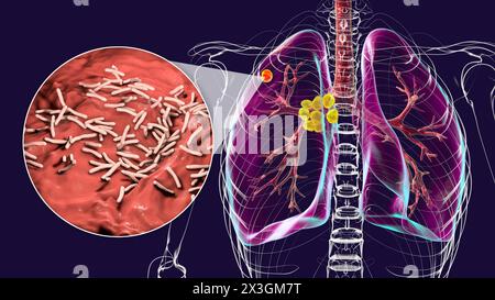 Illustration der primären Lungentuberkulose mit Ghon-Komplex und mediastinaler Lymphadenitis mit Nahaufnahme von Mycobacterium tuberculosis-Bakterien. Stockfoto