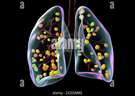 Illustration der Lungenhistoplasmose, einer Pilzinfektion, die durch Histoplasma capsulatum verursacht wird, mit kleinen Knoten, die in der Lunge verstreut sind. Stockfoto