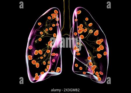 Illustration der Lungenhistoplasmose, einer Pilzinfektion, die durch Histoplasma capsulatum verursacht wird, mit kleinen Knoten, die in der Lunge verstreut sind. Stockfoto