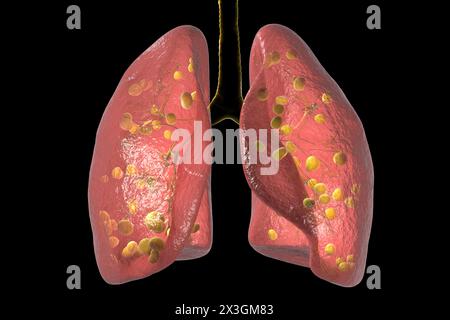 Illustration der Lungenhistoplasmose, einer Pilzinfektion, die durch Histoplasma capsulatum verursacht wird, mit kleinen Knoten, die in der Lunge verstreut sind. Stockfoto