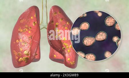 Illustration der Lungenhistoplasmose, einer durch Histoplasma capsulatum verursachten Pilzinfektion, mit kleinen, in der Lunge verstreuten Knoten und Nahaufnahme von Histoplasmahefen. Stockfoto