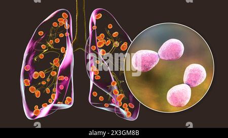 Illustration der Lungenhistoplasmose, einer durch Histoplasma capsulatum verursachten Pilzinfektion, mit kleinen, in der Lunge verstreuten Knoten und Nahaufnahme von Histoplasmahefen. Stockfoto