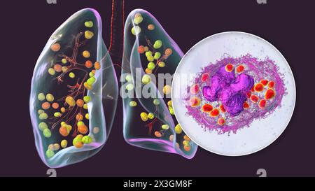 Illustration der Lungenhistoplasmose, einer durch Histoplasma capsulatum verursachten Pilzinfektion, mit kleinen, in der Lunge verstreuten Knoten und Nahaufnahme von Histoplasmahefen in Lungenmakrophagen. Stockfoto
