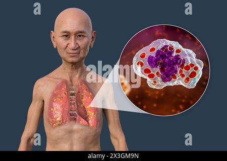 Illustration der Lungenhistoplasmose, einer durch Histoplasma capsulatum verursachten Pilzinfektion, mit kleinen, in der Lunge verstreuten Knoten und Histoplasmahefen in Lungenmakrophagen. Stockfoto