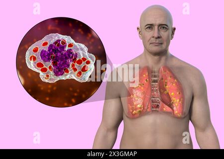 Illustration eines Mannes mit Lungenhistoplasmose, einer durch Histoplasma capsulatum verursachten Pilzinfektion, die kleine Knoten zeigt, die in der Lunge verstreut sind. Stockfoto