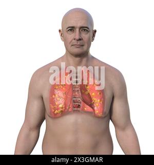 Illustration eines Mannes mit Lungenhistoplasmose, einer durch Histoplasma capsulatum verursachten Pilzinfektion, die kleine Knoten zeigt, die in der Lunge verstreut sind. Stockfoto