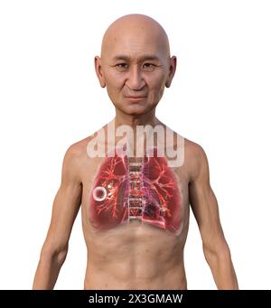 Illustration eines Mannes mit Lungen von kavernöser Tuberkulose. Stockfoto