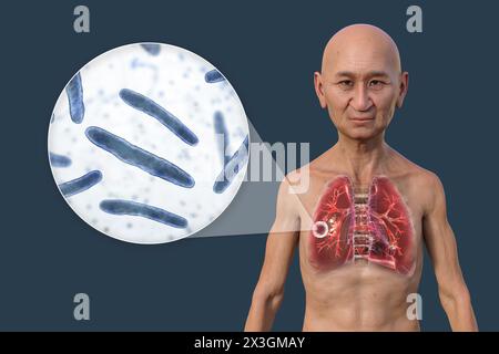 Illustration eines Mannes mit Lungen mit kavernöser Tuberkulose und Nahaufnahme von Mycobacterium tuberculosis-Bakterien. Stockfoto