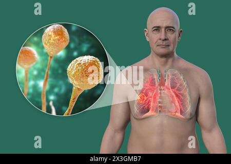 Illustration eines Mannes mit Lungenmukormykoseläsion und Nahaufnahme von Mucor-Pilzen, einem der Atiologen der Lungenmukormykose. Stockfoto